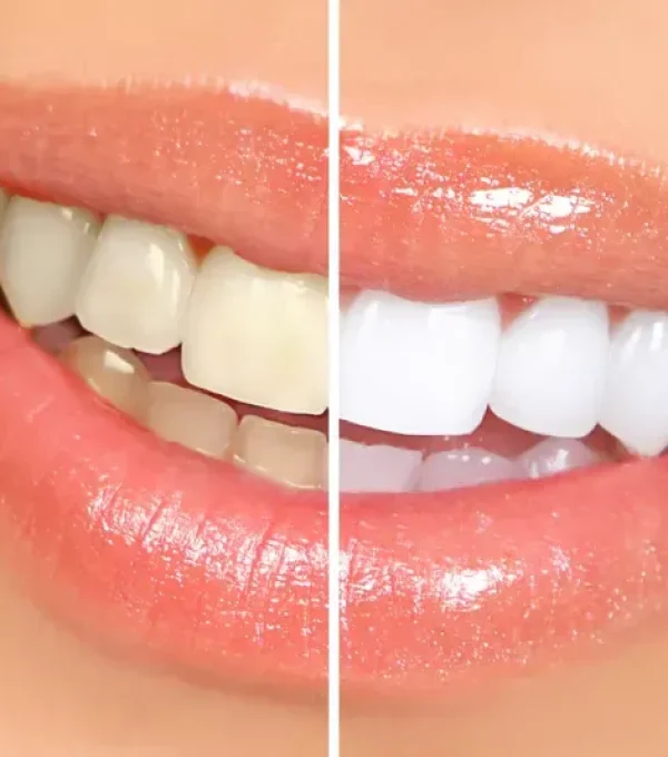 66822459bdab120be2646749_Teeth Whitening-p-800