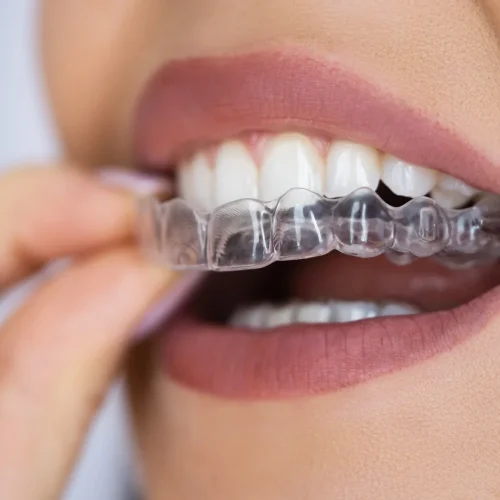 invisalign-appointments-1