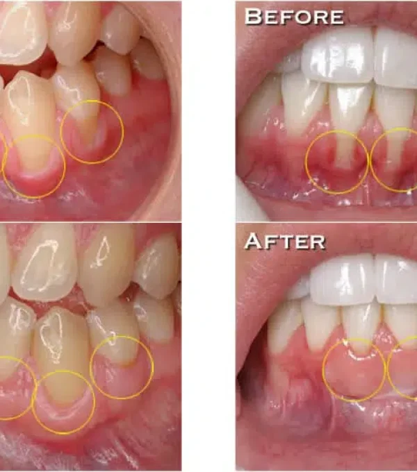 soft-tissue-gum-grafting-smiles-by-hanna