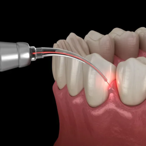 types-of-gum-surgery-and-why-you-might-need-one